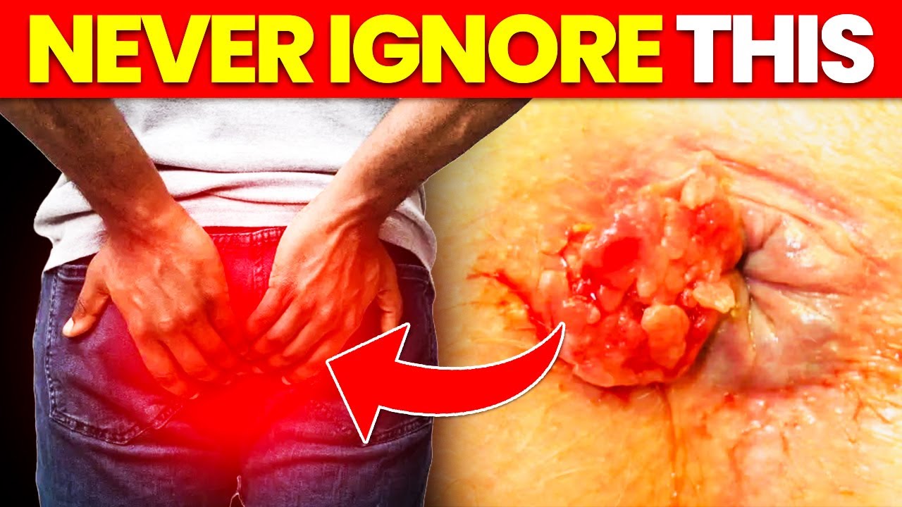 10 Symptoms Of BOWEL CANCER That Require URGENT Attention