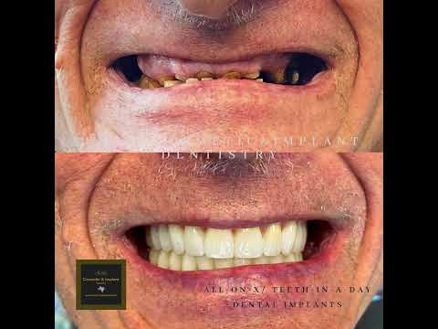 All On X Teeth In A Day Dental Implants Austin Cosmetic And Implant Dentistry
