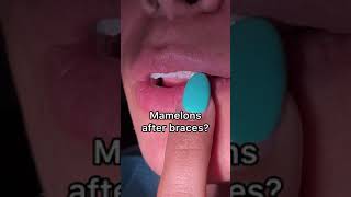 Braces off - Mamelons after braces - Tooth Time Family Dentistry New Braunfels