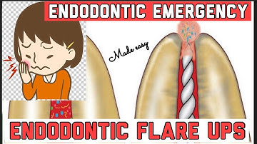 ENDODONTIC FLARE UPS II ENDODONTIC EMERGENCY DURING TREATMENT II HOW TO PREVENT AND MANAGE IT ??