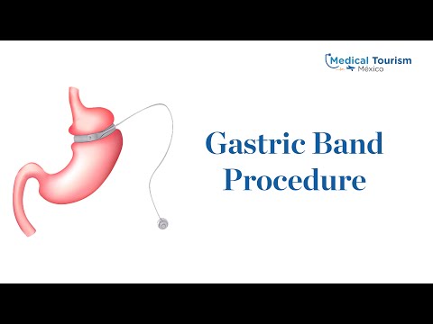 Gastric Band Procedure - Medical Tourism Mexico