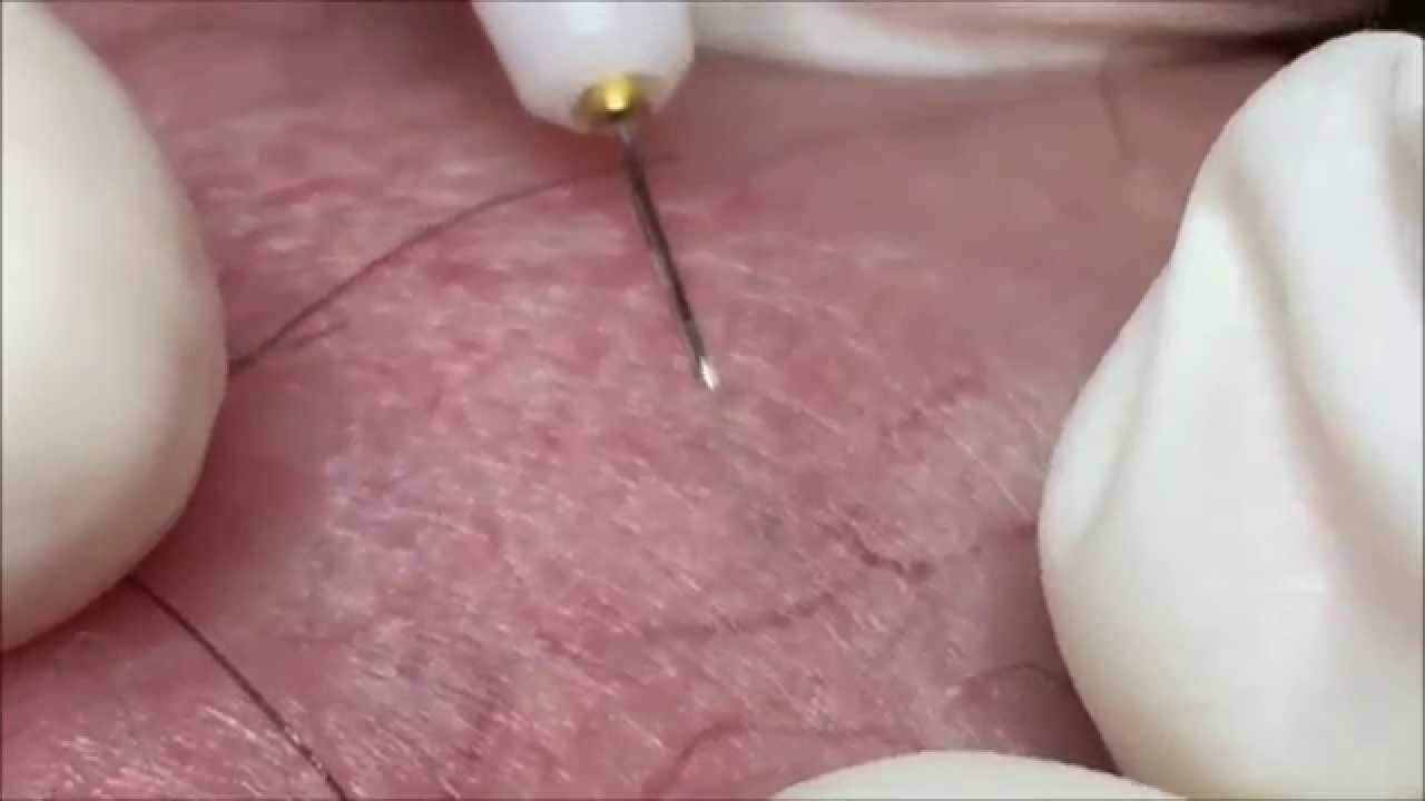 Electrolysis On Terminal Hairs Youtube