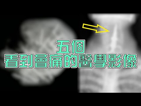 朋友在剔牙的時候千萬不要跟他講笑話【放射師到底射什麼Ep.28】
