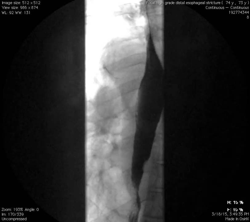 Esophagram Focal High Grade Distal Esophageal Stricture YouTube