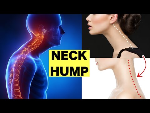 How to Fix NECK HUMP and SLIM FACE｜Can be done while