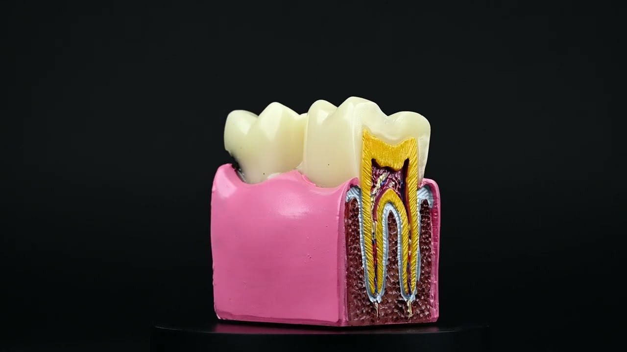 Dental Caries Model – Molar with Tooth Decay Model – for Student Display Human Tooth Anatomy Demonstration Tool