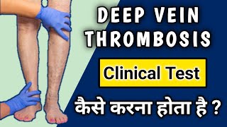 Deep vein thrombosis Clinical Examination | Homans Test for DVT