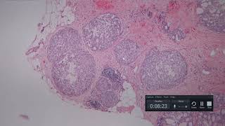 Breast Pathology Cases 5 through 7