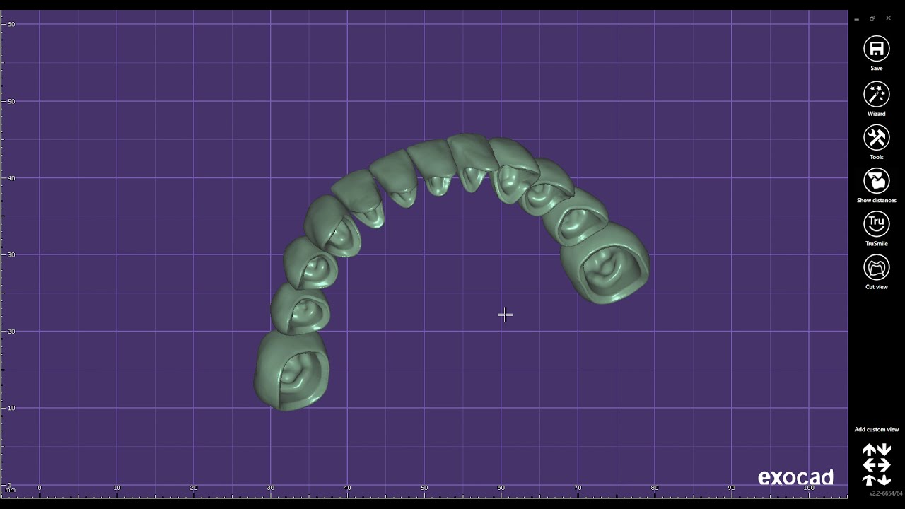 EXOCAD DentalCAD Case Thimble crown implant bridge Zirconium Crowns