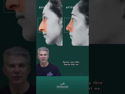 Video thumbnail: How Skin Thickness Affects Your Rhinoplasty Results | Dr. Corey Maas | The Maas Clinic · Maas Clinic - Facial Plastic & Aesthetic Surgery