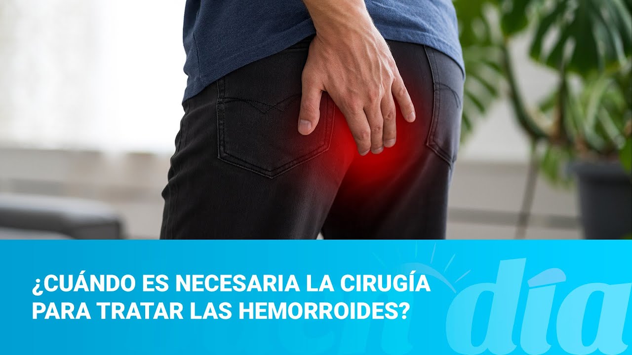 ¿Cuándo es necesaria la cirugía para tratar las hemorroides?