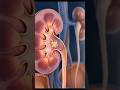 Kidney Stone Pain Inside Body 🤯 (3D) #viral #shorts #animation