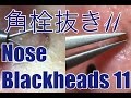 史上最大（※）の巨大角栓登場！！（※当社比）Big Nose Blackheads