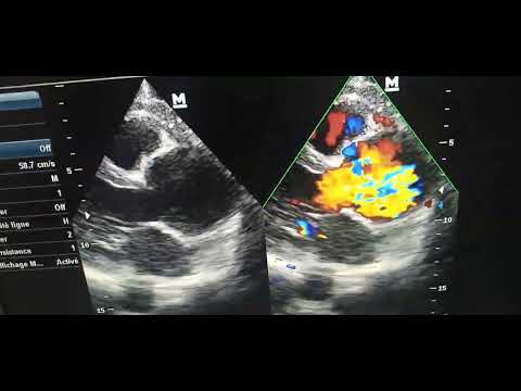 45 ans, Dissection