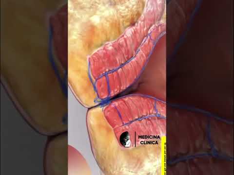 🔥Cirurgia de Hemorróida #shorts