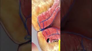 Cirurgia De Hemorróida 