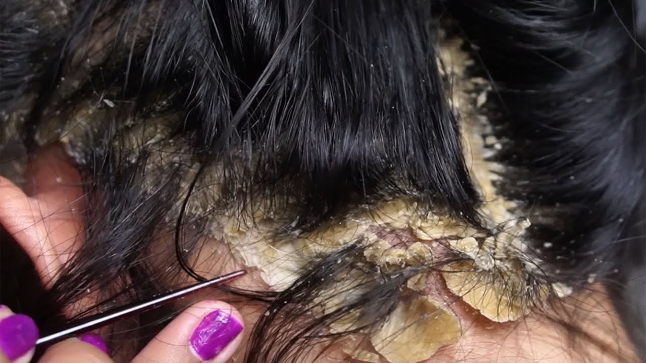 relaxing Treatment and Dandruff Removal Scratching#18