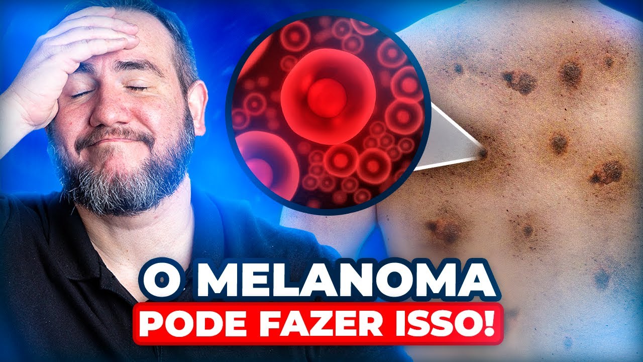 Duvidas mais frequentes sobre o Melanoma