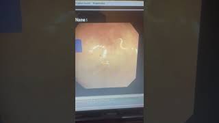Pinworm found during colonoscopy #worms #children #care