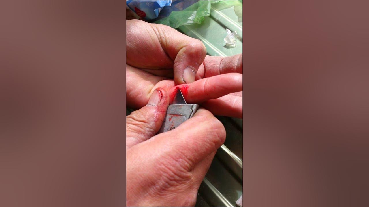 Splinter finger YouTube