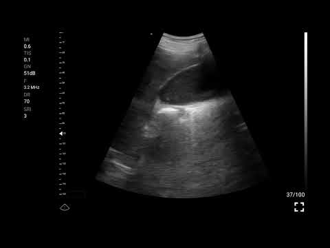 Dilated bile duct · B-mode · C5SH · 3.2 MHz scan preview