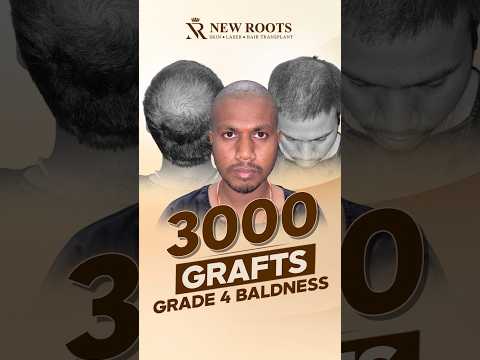 Grade 4 Baldness Hair Transplant in Raipur | 3000 Grafts Surgery #hairtransplant #shorts #ytshorts