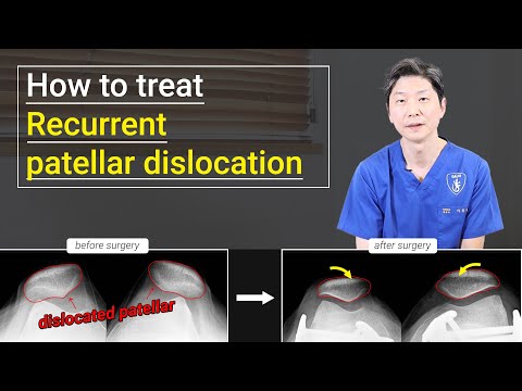 How to treat recurrent patellar dislocation?👨‍⚕️