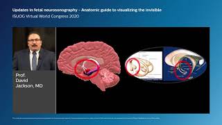 Updates in fetal neurosonography: an anatomic guide to visualizing the invisible