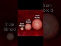 Have you ever wondered why doctors don't always remove fibroids from women #dr_couples143 #shorts