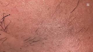 Ingrown hairs | relaxing video asmr #196