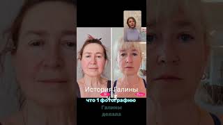Шок! Две разные женщины #фейспластика #какстатьмоложе #лицопосле50 #антивозрастнойуход #омоложение
