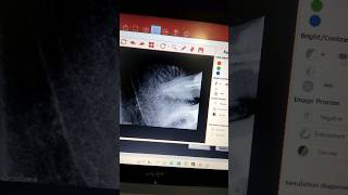 Kanal Müalicə Endontiya