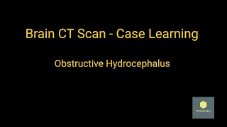Obstructive Hydrocephalus Brain CT Scan - Case Learning