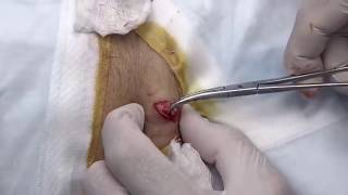 Large Epidermoid Cyst Removal! Cysts, Whiteheads, Dermatolgy Videos