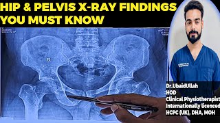How to Read Hip and Pelvis X-ray | Urdu | Hindi