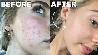 How I Cleared My Skin In 8 Weeks *naturally*