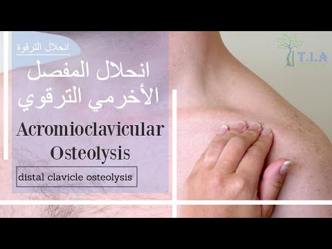 انحلال المفصل الأخرمي الترقوي    acromioclavicular osteolysis (subtitled)