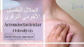 انحلال المفصل الأخرمي الترقوي    acromioclavicular osteolysis (subtitled)