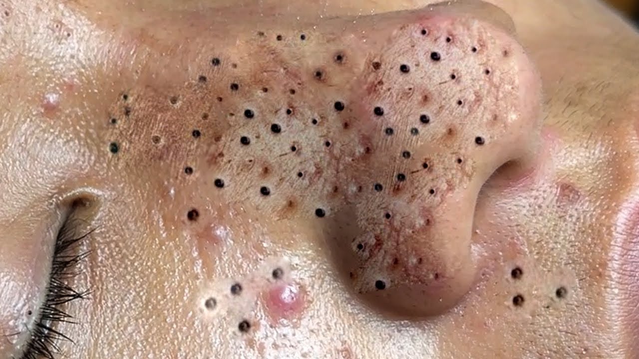 Unmasking Smoothness: Your Ultimate Guide to Blackheads on Inner Thighs Removing