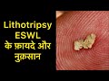 Lithotripsy (ESWL)Treatment Advantages and Disadvantages in Hindi | Lithotripsy Side effects