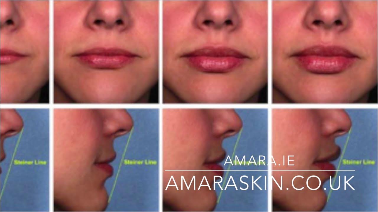 Шприц гиалуроновая кислота 1 мл. Филлер в губы сколько мл. Филлер в губы сколько мл. Филлер в губы сколько мл. Увеличение тонких губ 1 мл.