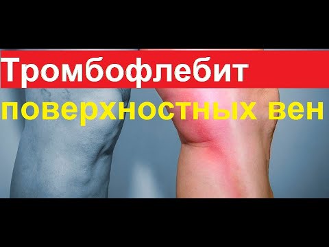 Тромбофлебит поверхностных вен