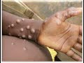 Monkey Pox Zoonotic virus