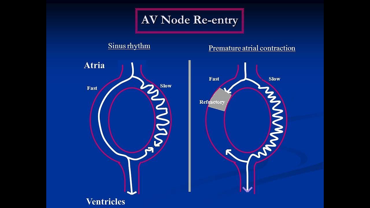 AV Nodal Reentry Supraventricular tachycardia ; Definition, Causes ...