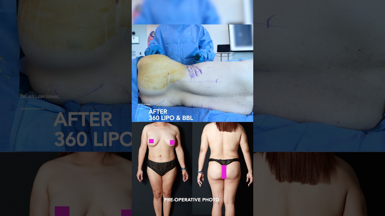 Операция по изменению пола — 360-градусная липосакция и BBL с ремоделированием рёбер! Результаты ...