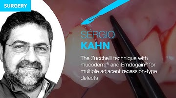 The Zucchelli technique with mucoderm® and Emdogain® for multiple adjacent recession-type defects