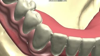 Case of the Week: Dentures Done DIgitally