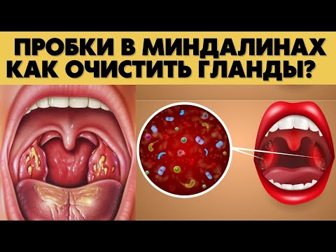 Как Очистить Гланды Пробки В Горле! Хронический Тонзиллит Белые Пятна В Горле