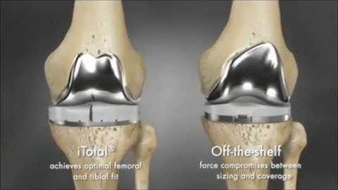 Conformis iFit  Image to Implant Technology