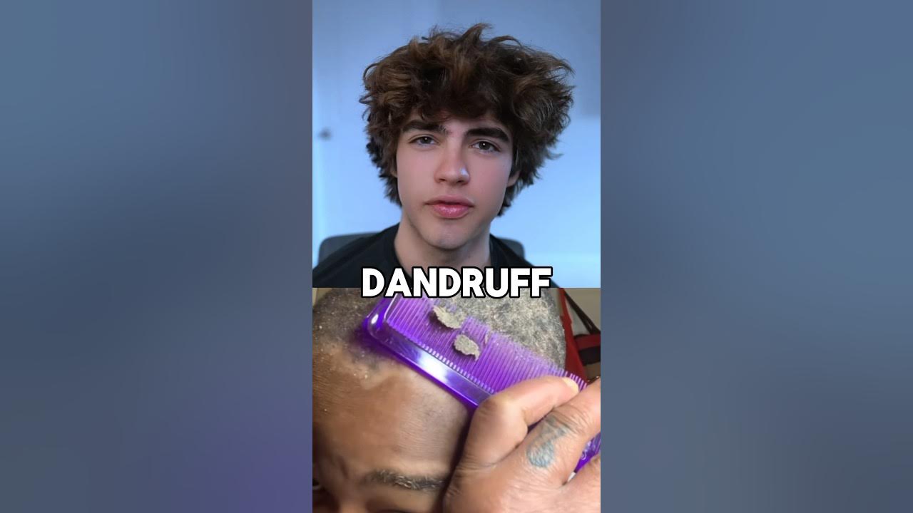 How to get rid of dandruff π± How to get rid of dandruff π±